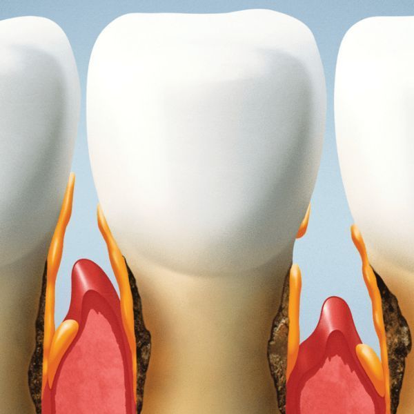 periimplantitis