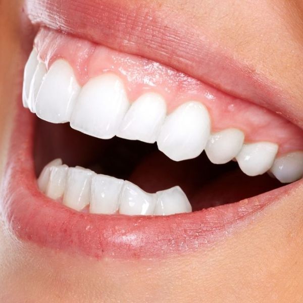 sonrisa gingival