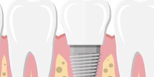 implante dental = diente natural