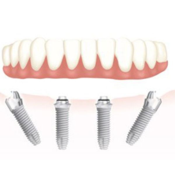 All On Four en implantes dentales
