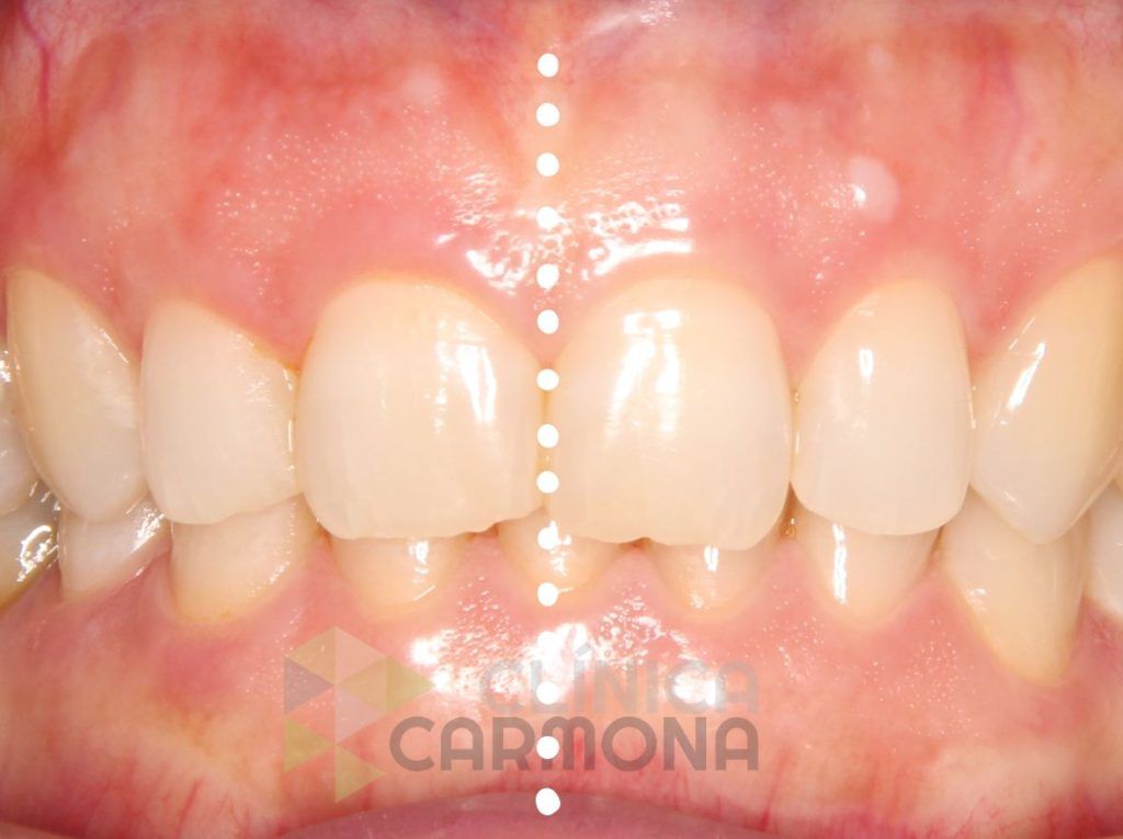 línea media dental