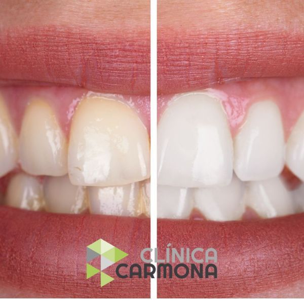 blanqueamiento dental