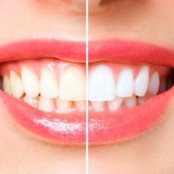 Blanqueamiento dental