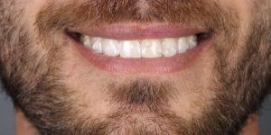 blanqueamiento dental