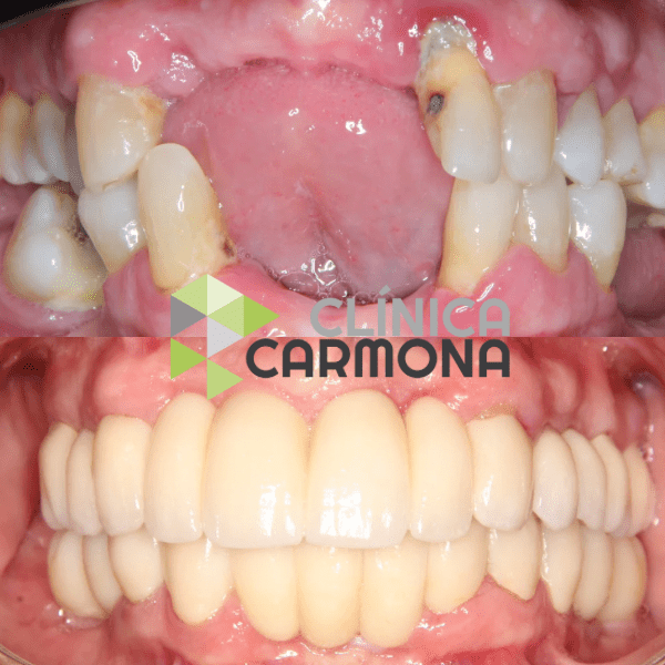 Caso Clínico Dental de Rehabilitación Completa con implantes