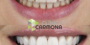 carillas dentales
