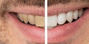 manchas dientes