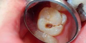caries