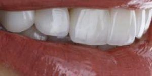carillas dentales