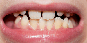 Dientes de Leche y Dientes Definitivos