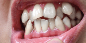 dientes apiñados