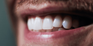 implantes dentales