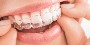 Ortodoncia invisible vs. brackets ¿Cuál es mejor (1)