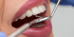 tallado selectivo dental