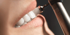limpieza dental totana