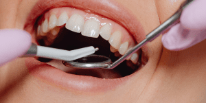 limpieza dental mazarrón