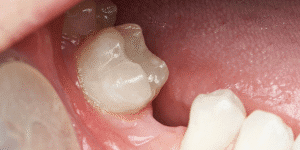 Errores al retrasar un implante dental