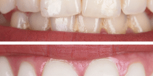 Por qué se oscurecen los dientes