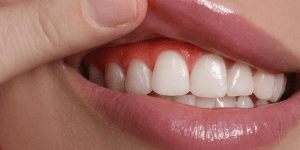 mantenimiento periodontal en Totana y Puerto de Mazarrón