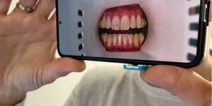 ortodoncia invisible a distancia con dental monitoring